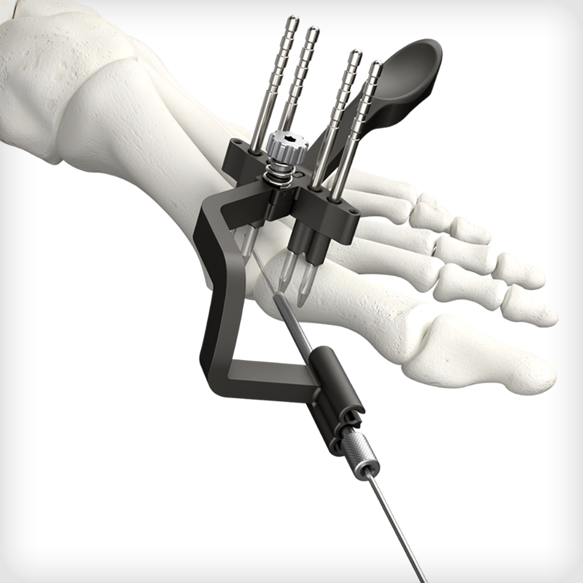 REFLEX® Nitinol Staples - Unite Foot and Ankle