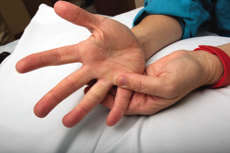Close-up of a patients hands